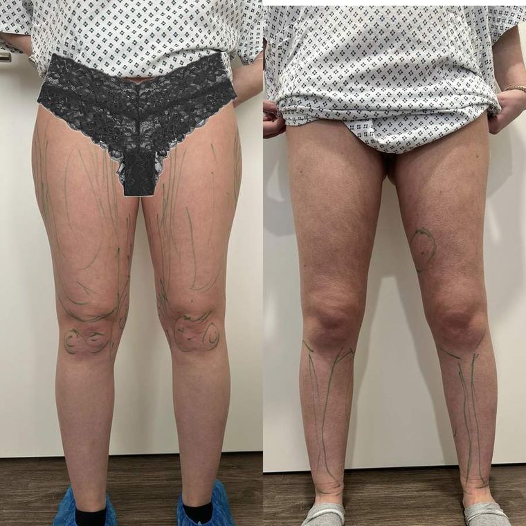 Lipödem-Behandlung Vorher — WAL-Liposuktion Düsseldorf (mit Einwilligung der Patientin)